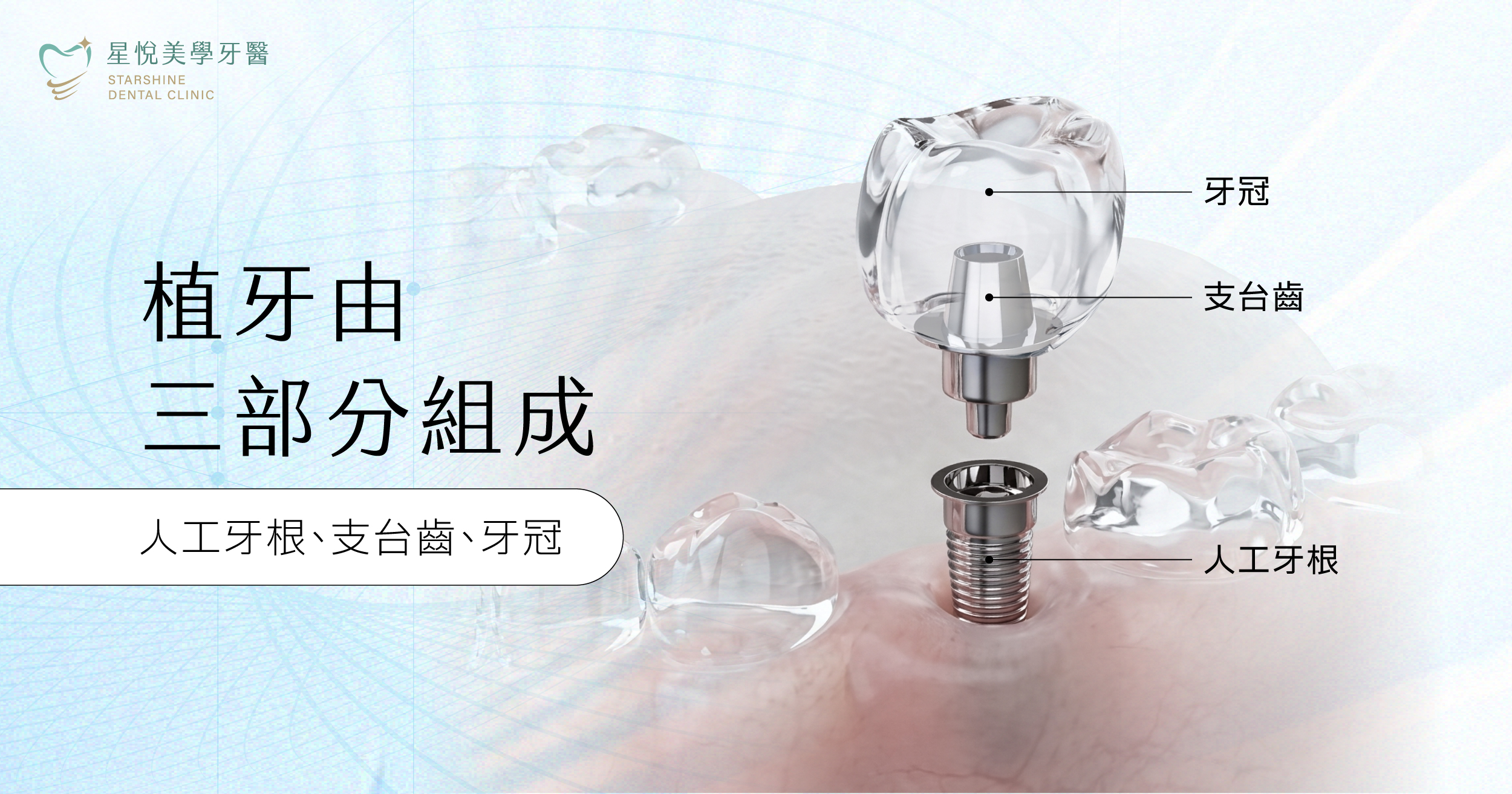 植牙是將鈦金屬人工牙根,植入齒槽骨(牙根周圍的骨頭)中,待植體跟骨頭長合在一起(骨整合)後,裝上支台齒與牙冠,完成牙齒重建。