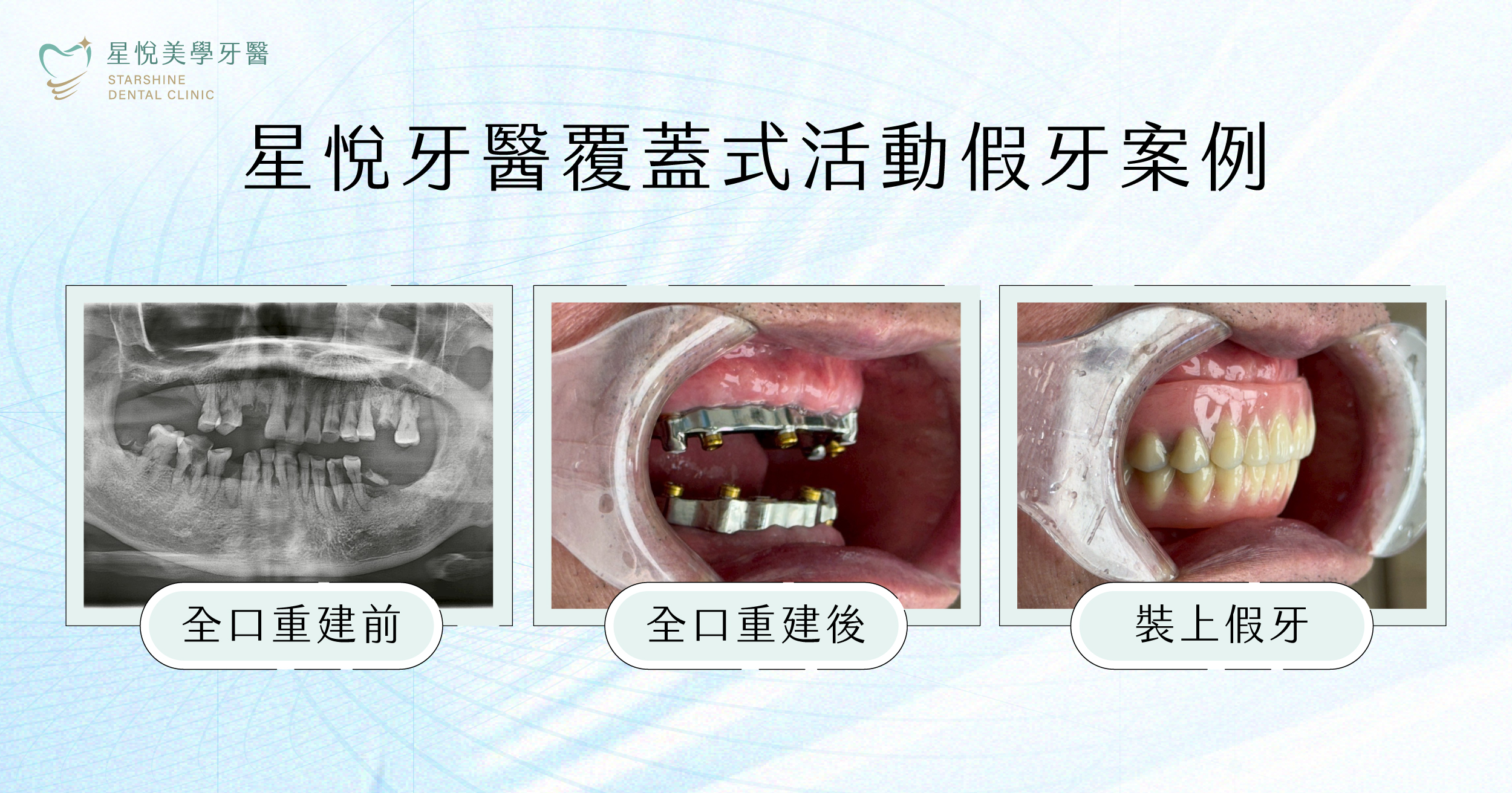 星悅美學牙醫覆蓋式活動假牙案例,全口重建術前術後對比照片