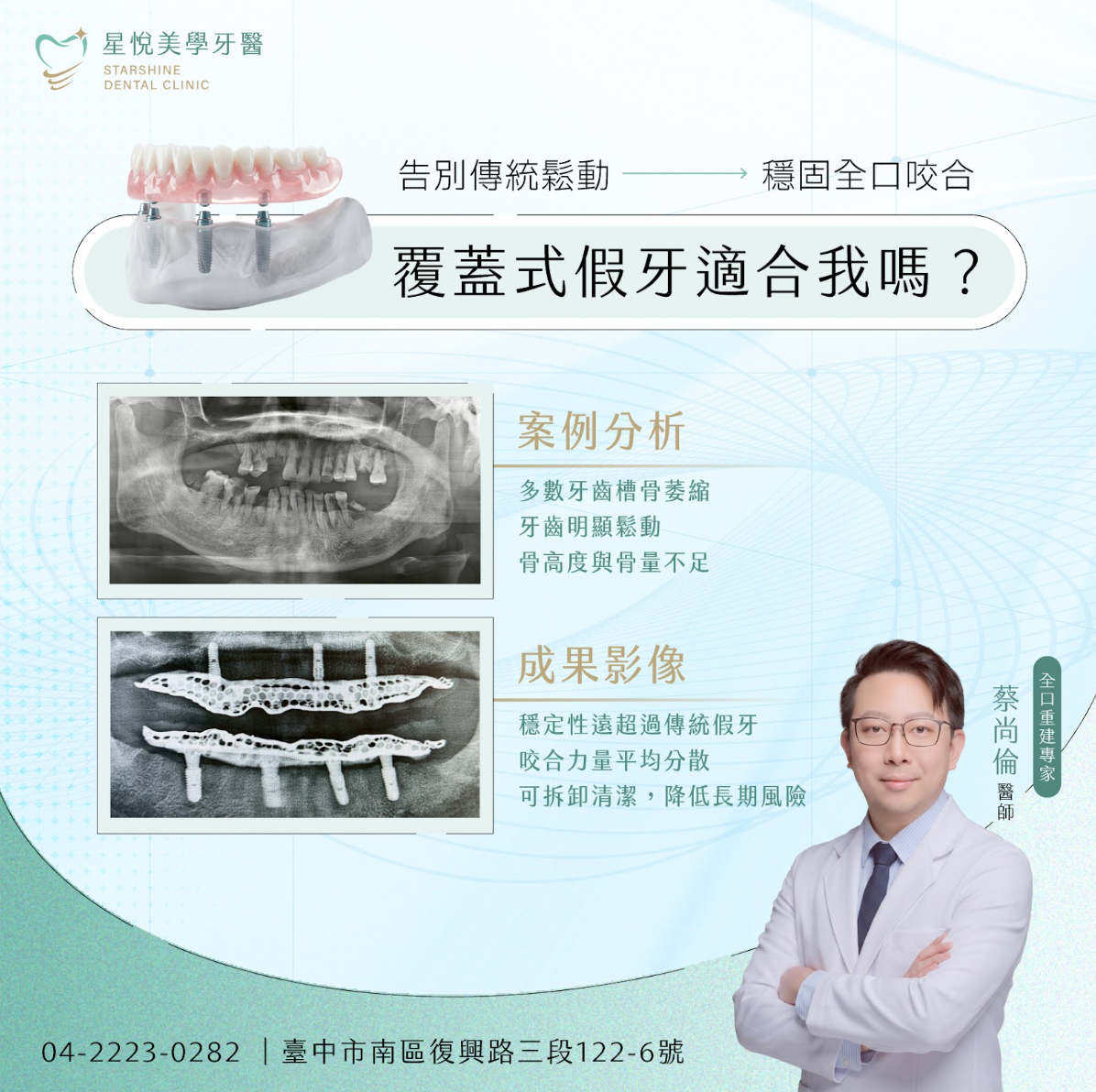 覆蓋式假牙案例