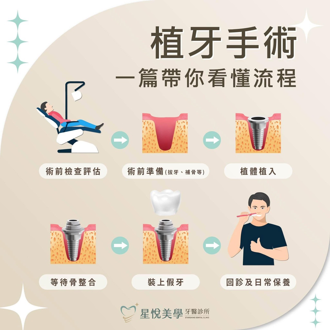 植牙過程一篇帶你看懂流程