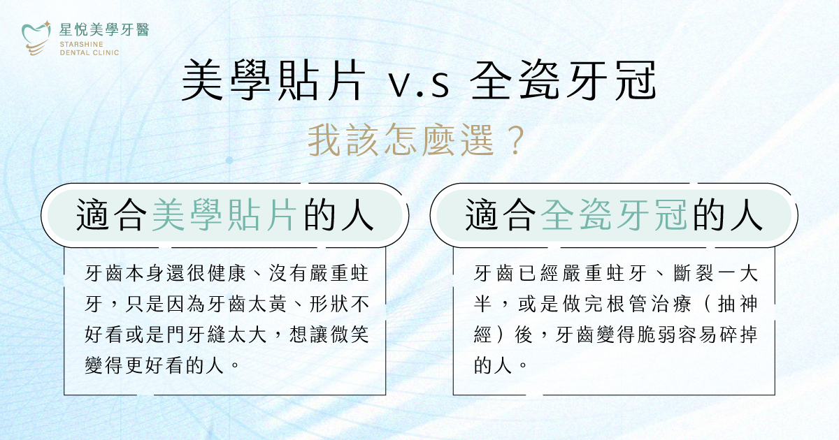 美學貼片與全瓷牙冠差異比較示意圖:覆蓋範圍、磨牙量與適用對象一覽