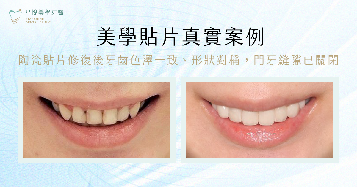 牙齒貼片治療前牙齒照片:前牙顏色不均、左右形狀不對稱,門牙有輕微縫隙與磨耗痕跡,美學貼片治療後牙齒照片:陶瓷貼片修復後牙齒色澤一致、形狀對稱,門牙縫隙已關閉