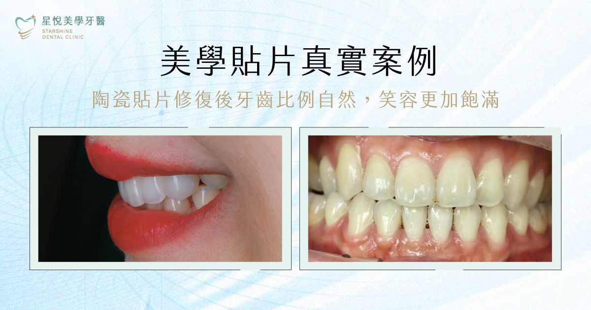 美學貼片治療前牙齒照片:前牙天生比例偏小偏短,微笑時露出牙縫
美學貼片治療後牙齒照片:陶瓷貼片修復後牙齒比例自然,笑容更加飽滿